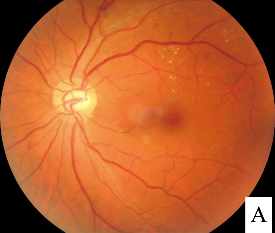 Diabetic retinopathy