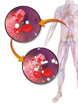 Hyperglycemia