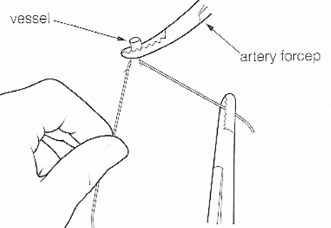 Ligature (medicine)